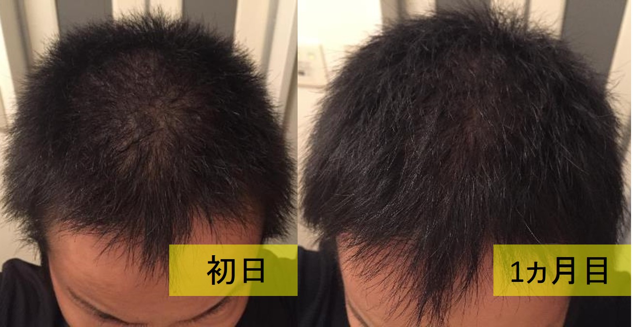 本気の育毛日記 リアップ効果によって髪の毛が太くなってきたか 1ヵ月目 Pのアトリエ
